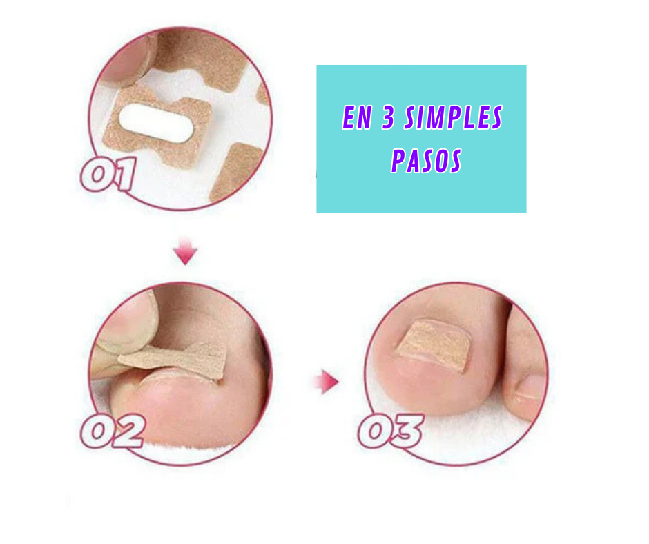 AliviaFlex - ¡Dile adiós al hongo de tu uña!